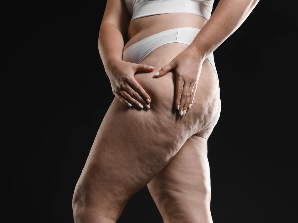 Mãos pressionando a pele da coxa evidenciando a textura característica do lipedema